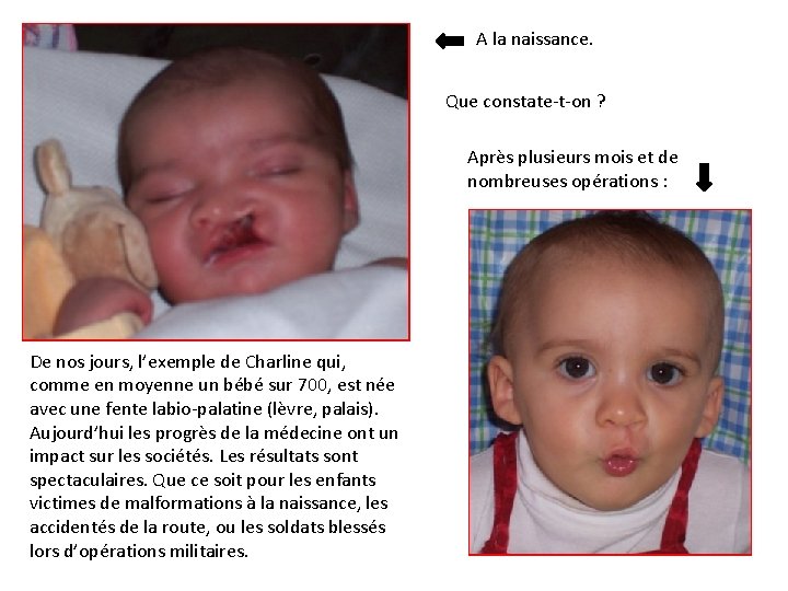  A la naissance. Que constate-t-on ? Après plusieurs mois et de nombreuses opérations