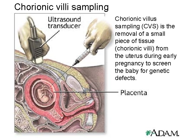 Chorionic villi sampling Chorionic villus sampling (CVS) is the removal of a small piece Chorionic villi sampling Chorionic villus sampling (CVS) is the removal of a small piece