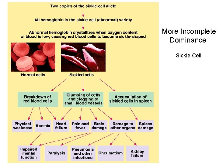 More Incomplete Dominance Sickle Cell More Incomplete Dominance Sickle Cell