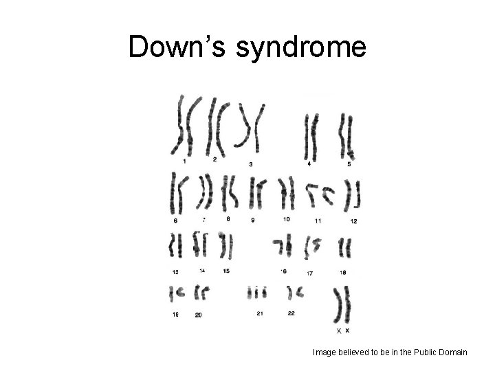 Down’s syndrome Image believed to be in the Public Domain 