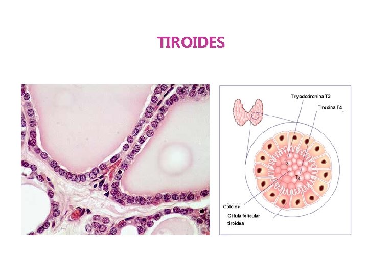 TIROIDES 