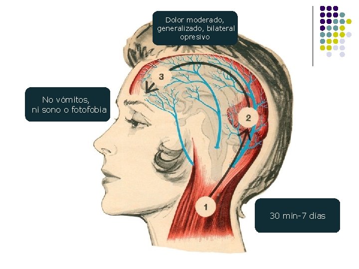 Dolor moderado, generalizado, bilateral opresivo No vómitos, ni sono o fotofobia 30 min-7 días