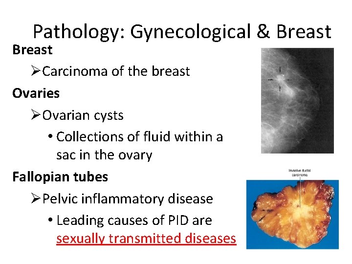 Pathology: Gynecological & Breast ØCarcinoma of the breast Ovaries ØOvarian cysts • Collections of