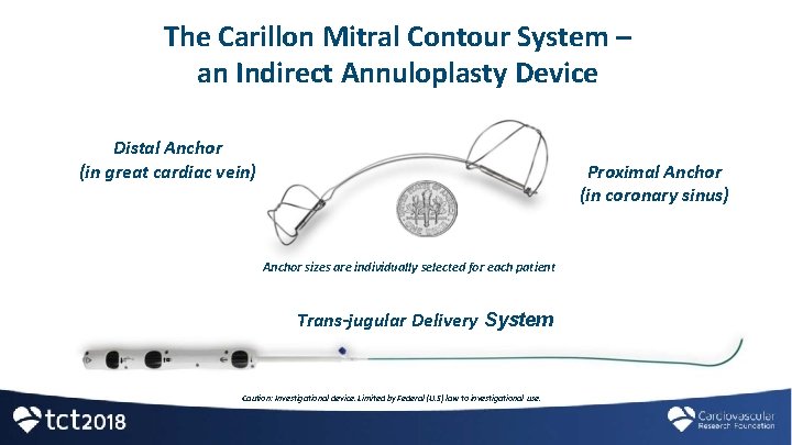 The Carillon Mitral Contour System – an Indirect Annuloplasty Device Distal Anchor (in great