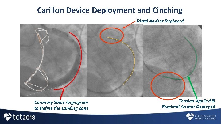 Carillon Device Deployment and Cinching Distal Anchor Deployed Coronary Sinus Angiogram to Define the