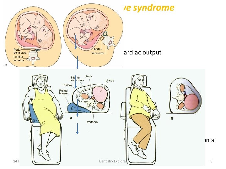 Supine hypotensive syndrome • During 2 nd and 3 rdtrimester, Patient in the supine