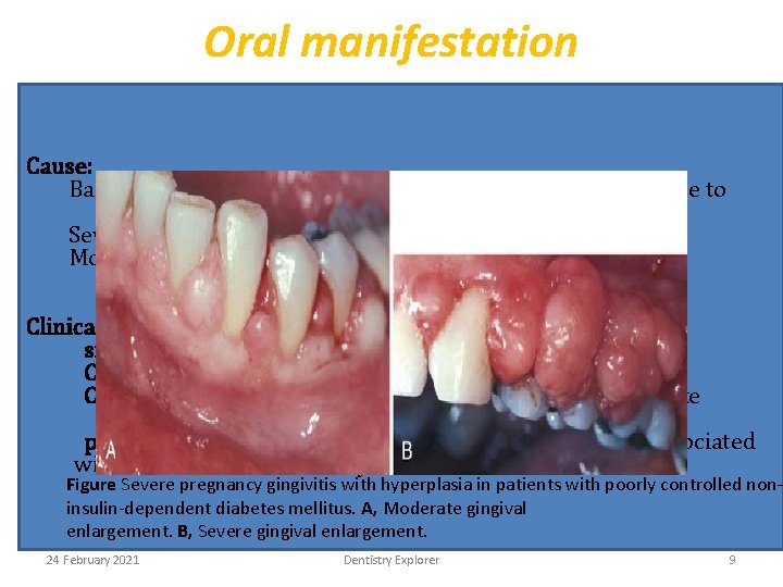 Oral manifestation Cause: Bacterial plaque, pregnancy accentuates the gingival response to plaque & modifies