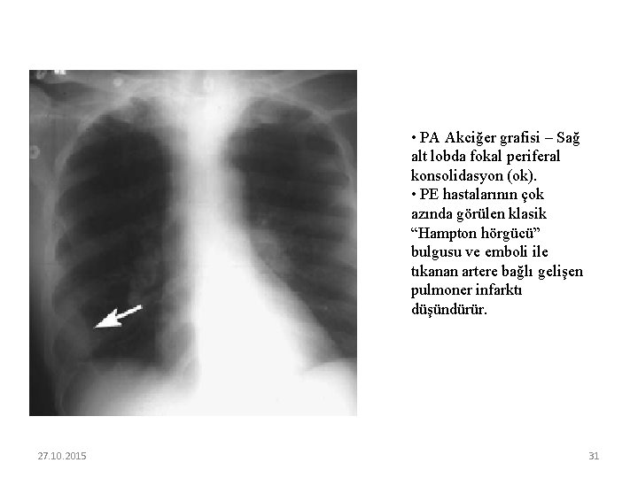  • PA Akciğer grafisi – Sağ alt lobda fokal periferal konsolidasyon (ok). •