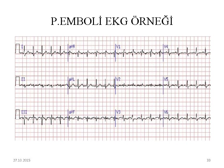 P. EMBOLİ EKG ÖRNEĞİ 27. 10. 2015 33 