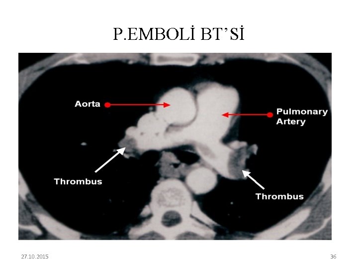 P. EMBOLİ BT’Sİ 27. 10. 2015 36 