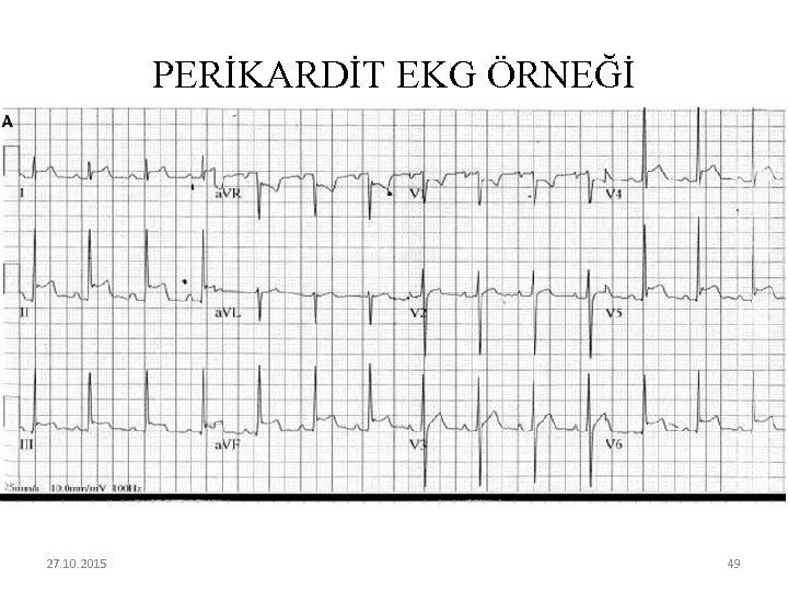 PERİKARDİT EKG ÖRNEĞİ 27. 10. 2015 49 