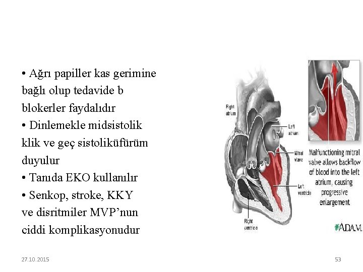  • Ağrı papiller kas gerimine bağlı olup tedavide b blokerler faydalıdır • Dinlemekle