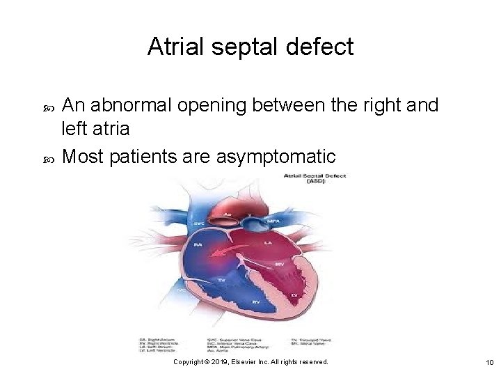 Atrial septal defect An abnormal opening between the right and left atria Most patients