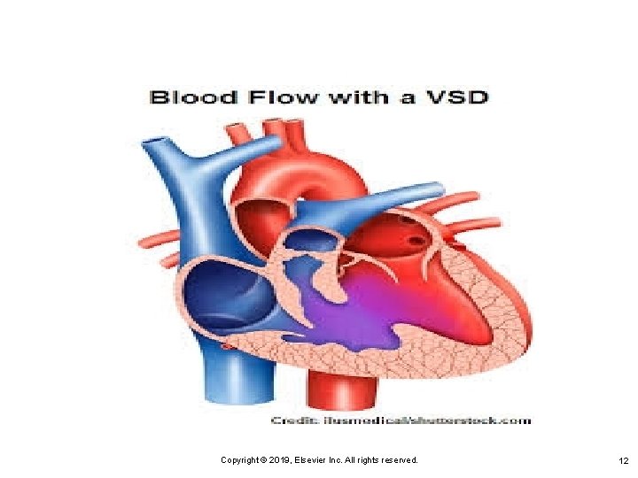 Copyright © 2019, Elsevier Inc. All rights reserved. 12 