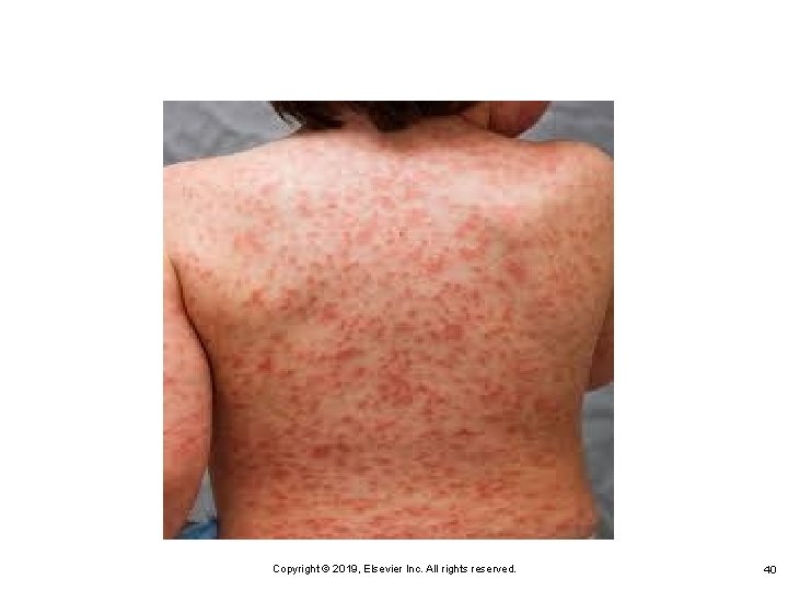 Copyright © 2019, Elsevier Inc. All rights reserved. 40 Copyright © 2019, Elsevier Inc. All rights reserved. 40