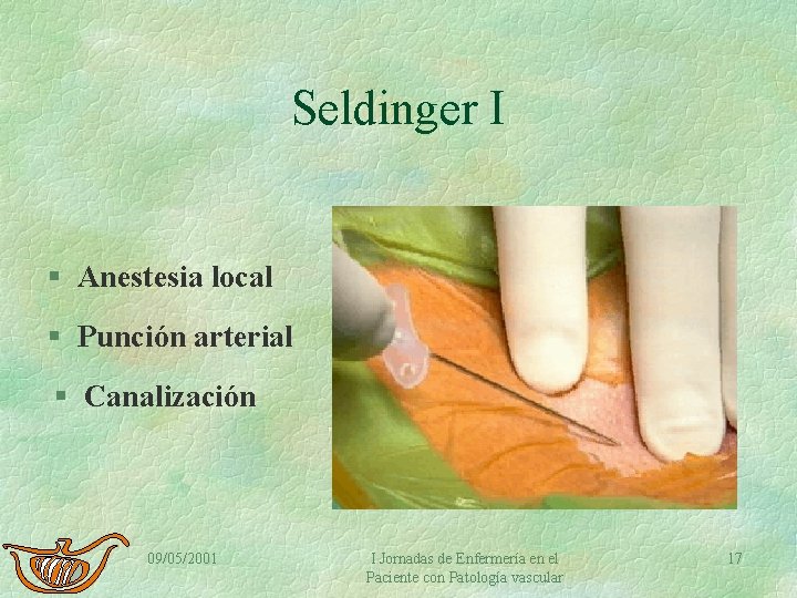 Seldinger I § Anestesia local § Punción arterial § Canalización 09/05/2001 I Jornadas de