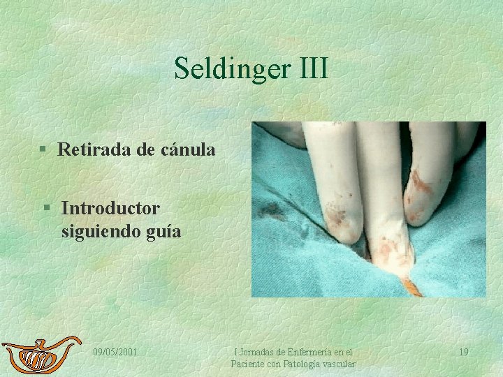 Seldinger III § Retirada de cánula § Introductor siguiendo guía 09/05/2001 I Jornadas de