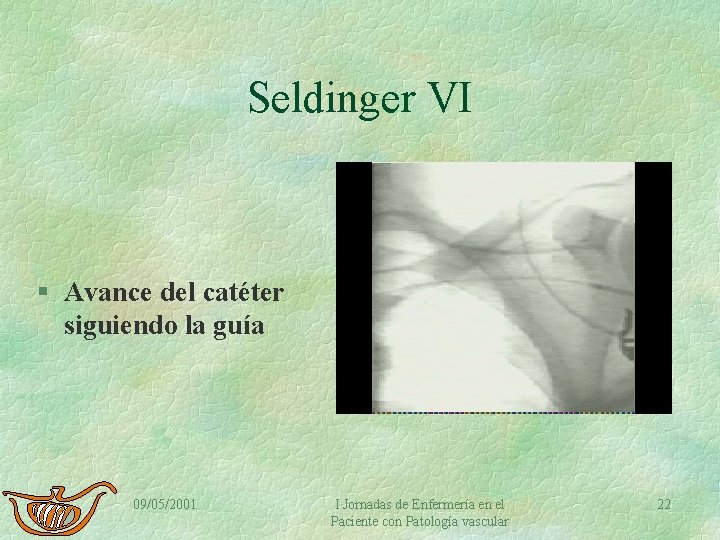 Seldinger VI § Avance del catéter siguiendo la guía 09/05/2001 I Jornadas de Enfermería