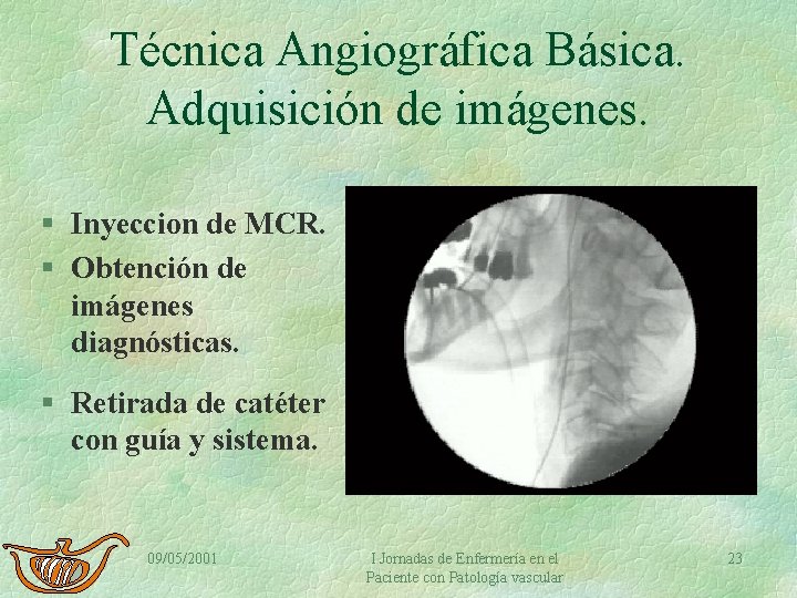 Técnica Angiográfica Básica. Adquisición de imágenes. § Inyeccion de MCR. § Obtención de imágenes