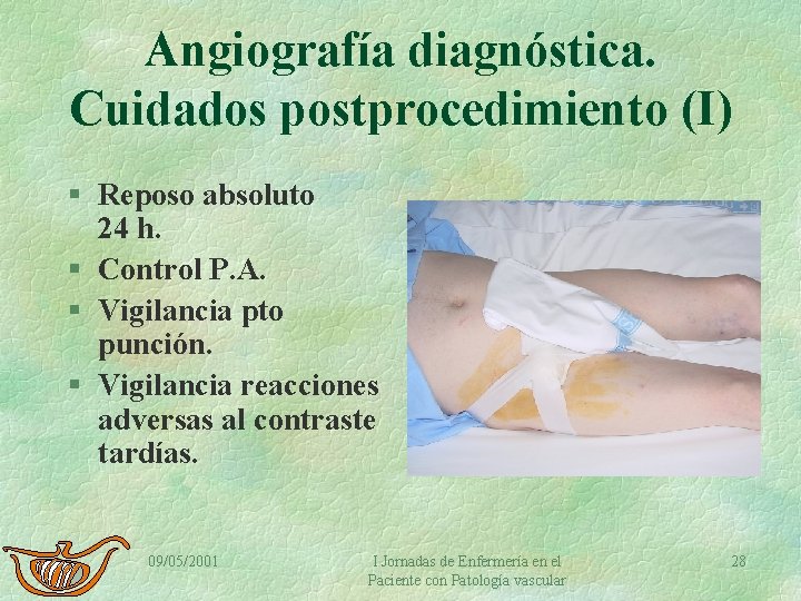 Angiografía diagnóstica. Cuidados postprocedimiento (I) § Reposo absoluto 24 h. § Control P. A.