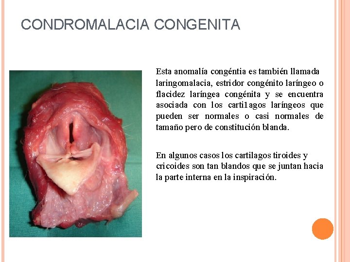 CONDROMALACIA CONGENITA Esta anomalía congéntia es también llamada laringomalacia, estridor congénito laríngeo o flacidez