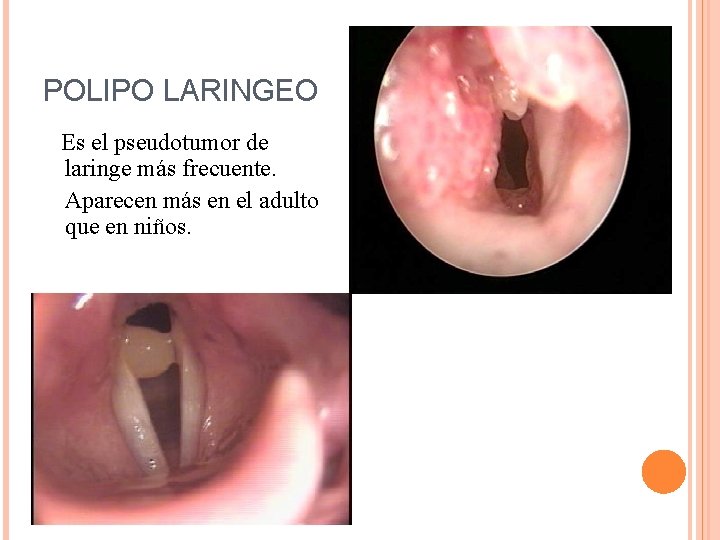 POLIPO LARINGEO Es el pseudotumor de laringe más frecuente. Aparecen más en el adulto