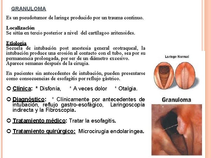 GRANULOMA Es un pseudotumor de laringe producido por un trauma continuo. Localización Se sitúa