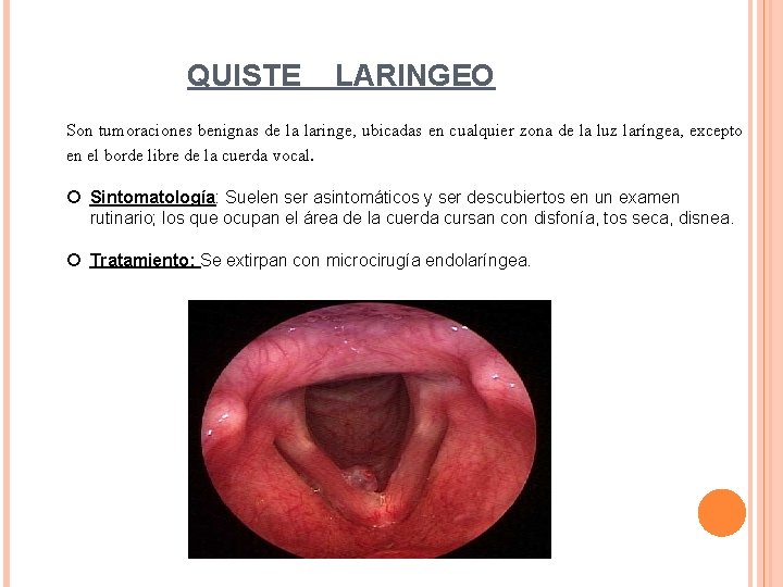 QUISTE LARINGEO Son tumoraciones benignas de la laringe, ubicadas en cualquier zona de la