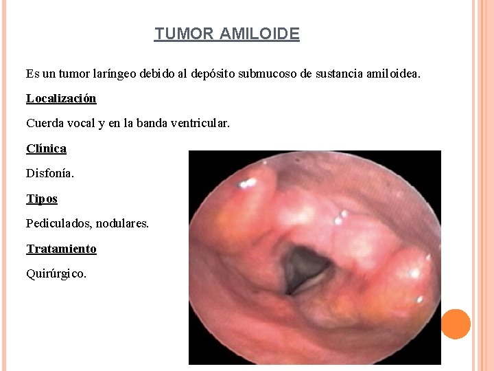 TUMOR AMILOIDE Es un tumor laríngeo debido al depósito submucoso de sustancia amiloidea. Localización