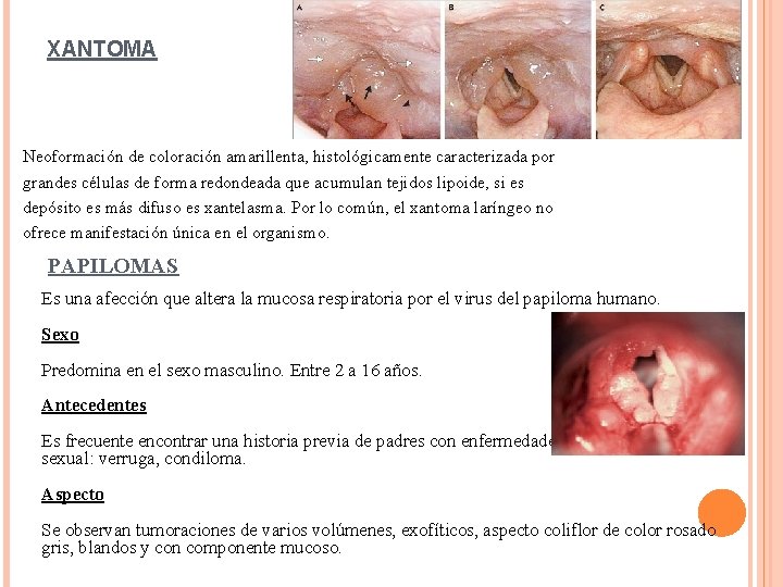 XANTOMA Neoformación de coloración amarillenta, histológicamente caracterizada por grandes células de forma redondeada que