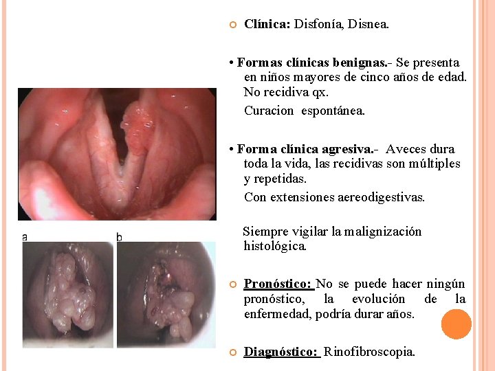  Clínica: Disfonía, Disnea. • Formas clínicas benignas. - Se presenta en niños mayores
