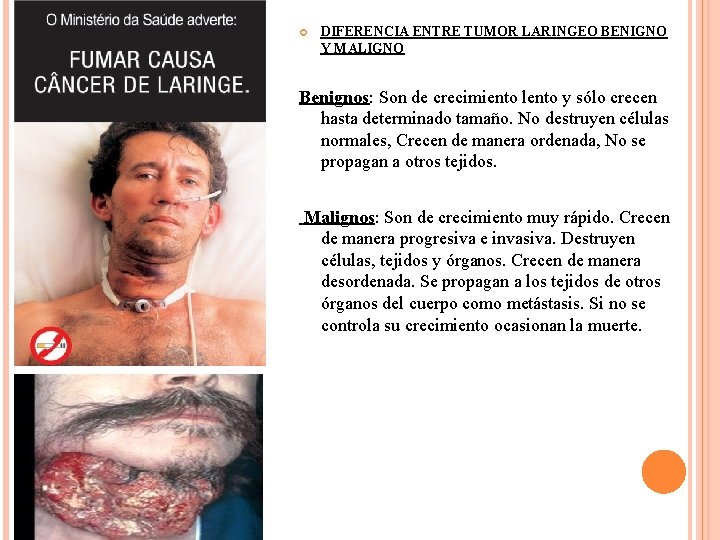  DIFERENCIA ENTRE TUMOR LARINGEO BENIGNO Y MALIGNO Benignos: Son de crecimiento lento y