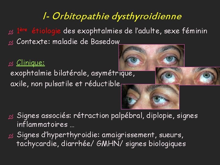 I- Orbitopathie dysthyroidienne 1ère étiologie des exophtalmies de l’adulte, sexe féminin Contexte: maladie de