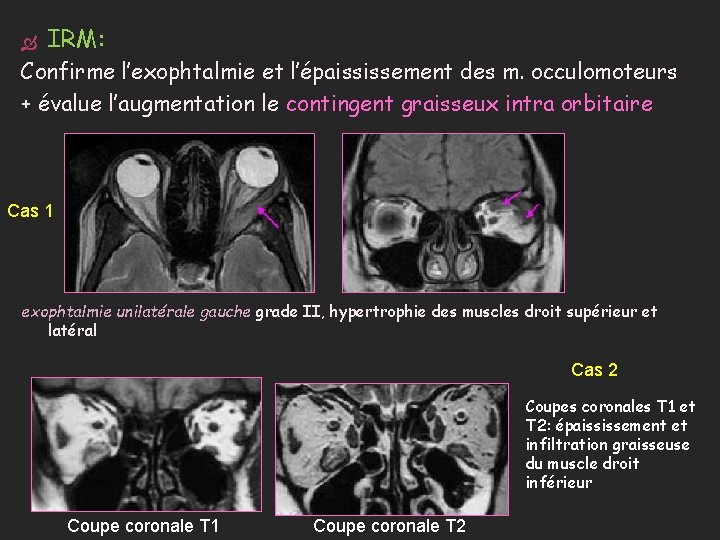  IRM: Confirme l’exophtalmie et l’épaississement des m. occulomoteurs + évalue l’augmentation le contingent