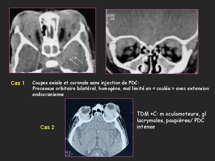 Cas 1 Coupes axiale et coronale sans injection de PDC: Processus orbitaire bilatéral, homogène,