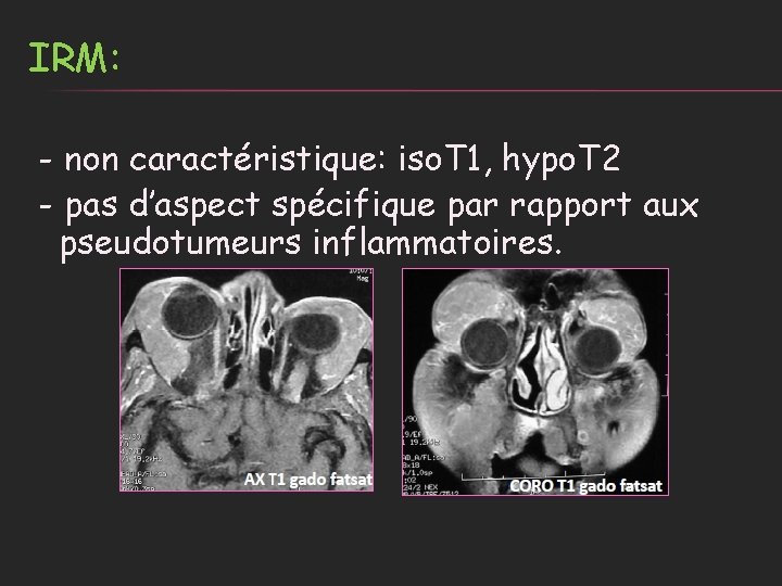 IRM: - non caractéristique: iso. T 1, hypo. T 2 - pas d’aspect spécifique