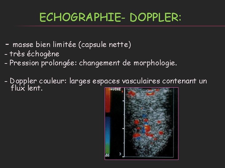 ECHOGRAPHIE- DOPPLER: - masse bien limitée (capsule nette) - très échogène - Pression prolongée: