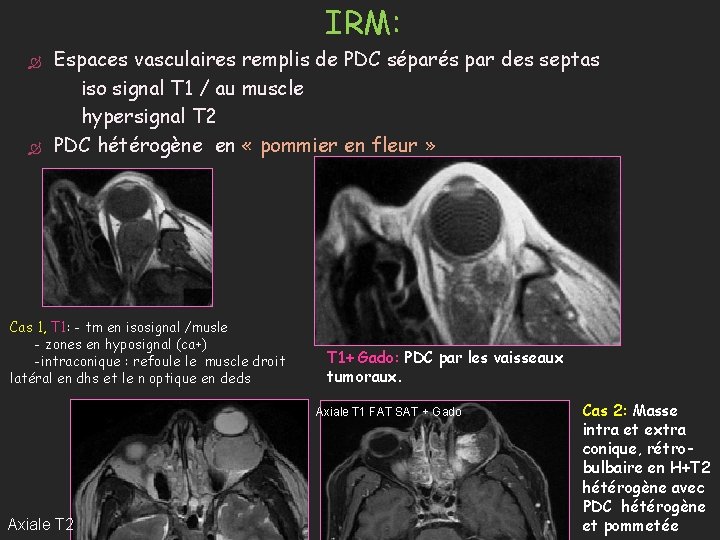 IRM: Espaces vasculaires remplis de PDC séparés par des septas iso signal T 1