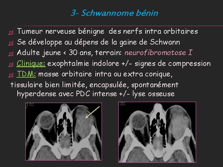 3 - Schwannome bénin Tumeur nerveuse bénigne des nerfs intra orbitaires Se développe au