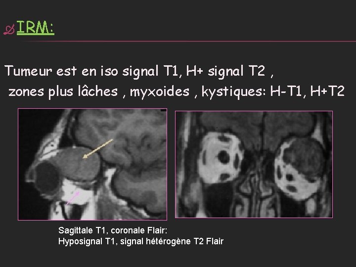  IRM: Tumeur est en iso signal T 1, H+ signal T 2 ,