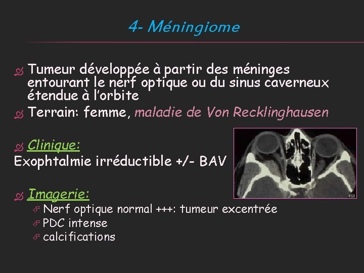 4 - Méningiome Tumeur développée à partir des méninges entourant le nerf optique ou