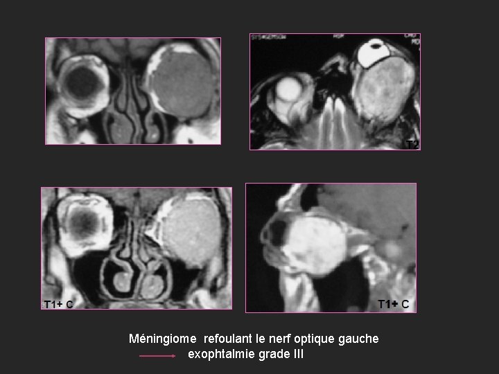Méningiome refoulant le nerf optique gauche exophtalmie grade III 