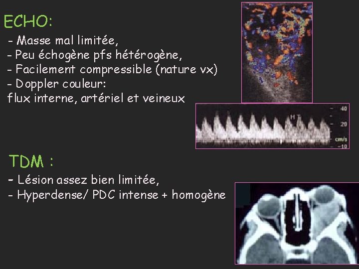 ECHO: - Masse mal limitée, - Peu échogène pfs hétérogène, - Facilement compressible (nature