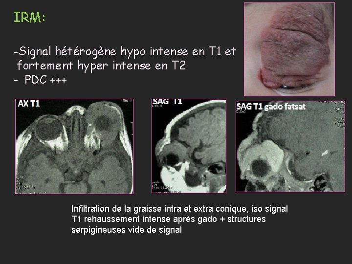 IRM: -Signal hétérogène hypo intense en T 1 et fortement hyper intense en T