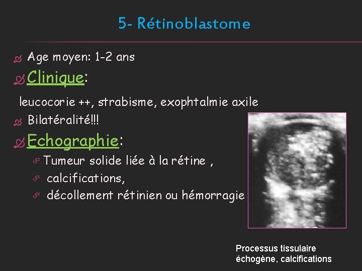 5 - Rétinoblastome Age moyen: 1 -2 ans Clinique: leucocorie ++, strabisme, exophtalmie axile