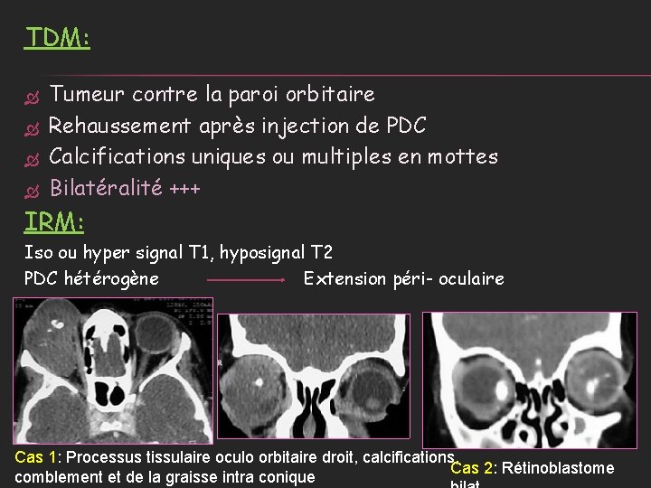 TDM: Tumeur contre la paroi orbitaire Rehaussement après injection de PDC Calcifications uniques ou