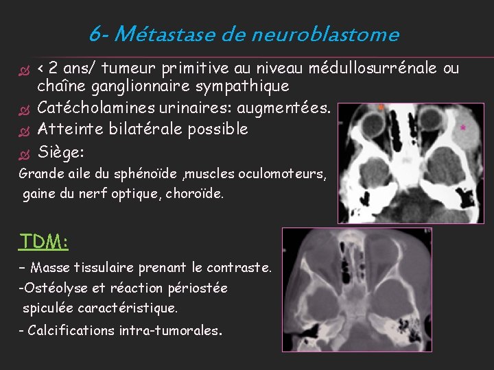 6 - Métastase de neuroblastome < 2 ans/ tumeur primitive au niveau médullosurrénale ou