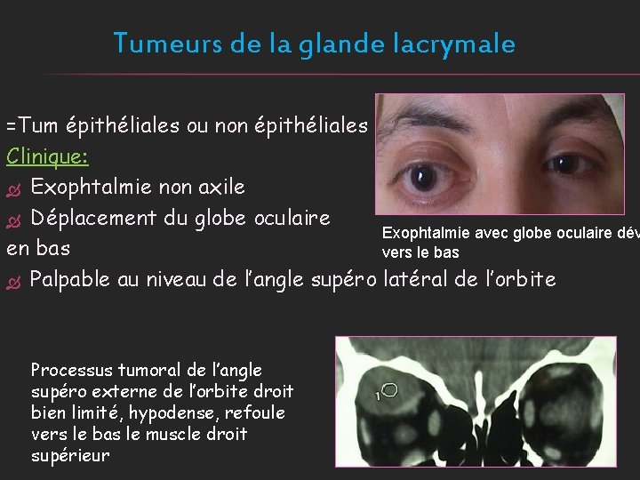Tumeurs de la glande lacrymale =Tum épithéliales ou non épithéliales Clinique: Exophtalmie non axile