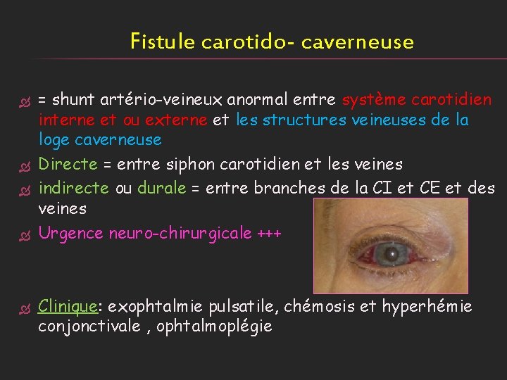 Fistule carotido- caverneuse = shunt artério-veineux anormal entre système carotidien interne et ou externe