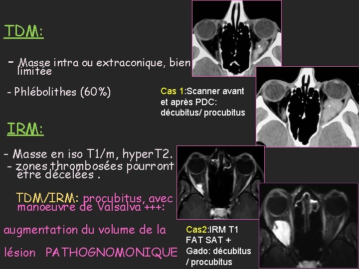 TDM: - Masse intra ou extraconique, bien limitée - Phlébolithes (60%) IRM: Cas 1: